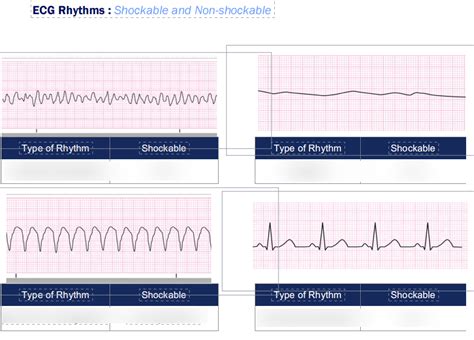 Diagram of 6) ECG SHOCKABLE AND NON SHOCKABLE | Quizlet