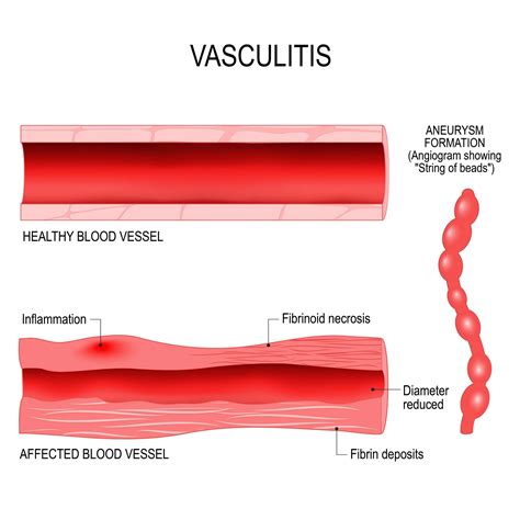 Vasculitis