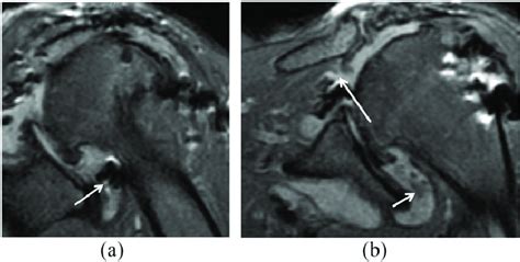 Image result for Subacromial Decompression Rotator Cuff Repair