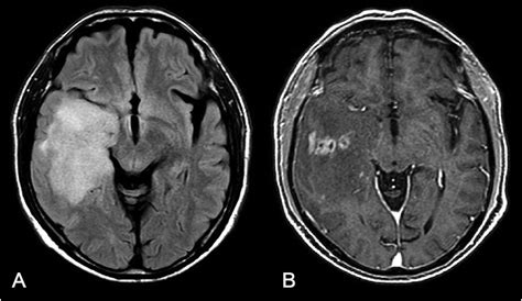 'I Have Been an Anomaly': Transcortical Sensory Aphasia - The American ...