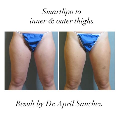 Before & After Gallery | QnA Cosmetic Surgery & Medical Spa