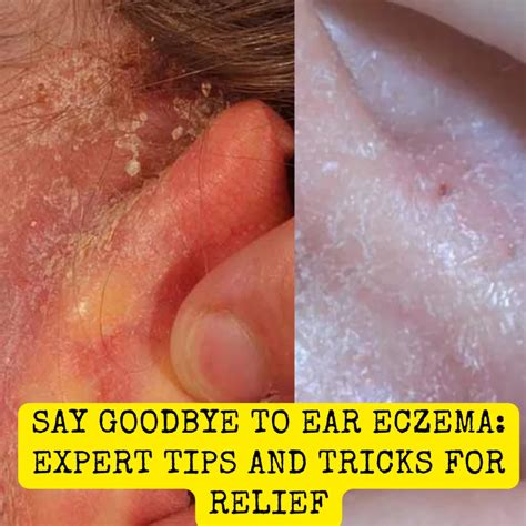Say Goodbye to Ear Eczema: Expert Tips and Tricks for Relief