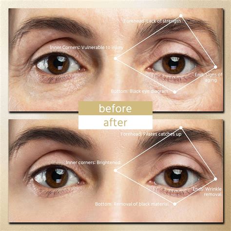 ZoGoo Under Eyes Face Red Light Therapy Massager, Eye Led India | Ubuy