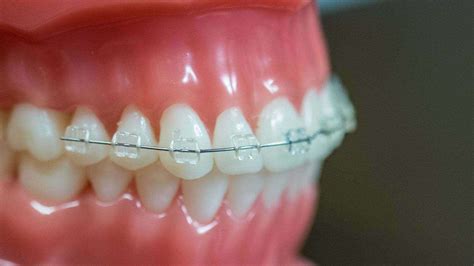 Clear Ceramic Braces With Colored Bands