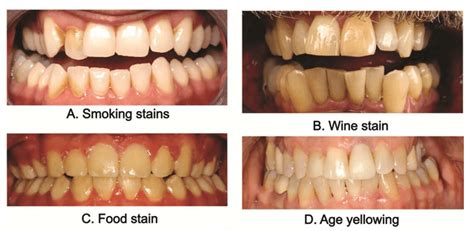 https://dentistpeshawar.pk/wp-content/uploads/2024/10/Teeth-stains-due-to-wine-smoking-and-age-related.webp?utm_source=chatgpt.com