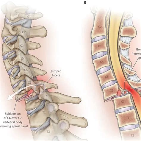 Spinal Cord Compression 的图像结果