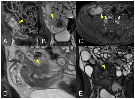 Small Bowel Imaging from Stepchild of Roentgenology to MR Enterography ...