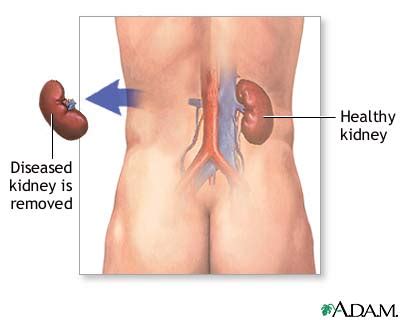 Image result for Nephrectomy Procedure