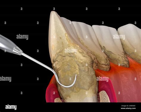 Oral hygiene: Scaling and root planing of Periodontitis stage 3 (conventional periodontal ...