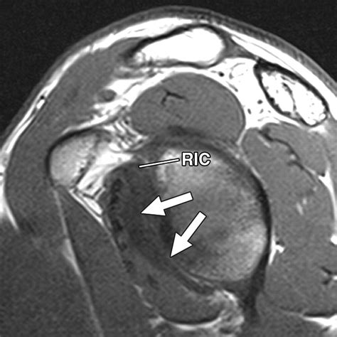 Rotator Interval Capsule at Kaitlyn Maund blog
