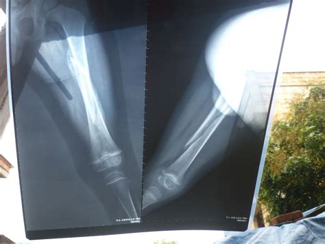 骨折1月5天，受伤腿比正常腿短1CM左右，拍片如下： 请问各位需要重新做手术吗？_百度知道