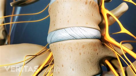 Image result for Lumbar Discogram