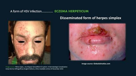 Kaposi Varicelliform Eruption | PPTX