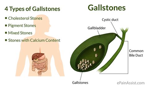 What are Gallstones|Types|Causes|Symptoms|Treatment|Risk Factors
