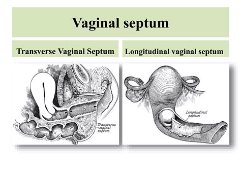 Congenital malformations of genital organs | PPTX