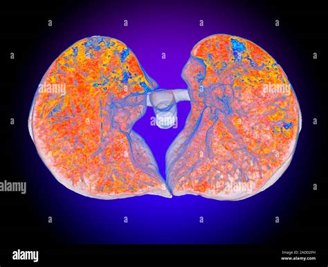 SARS-CoV lung damage. Coloured 3D computed tomography (CT) scan of the lungs of a patient with ...