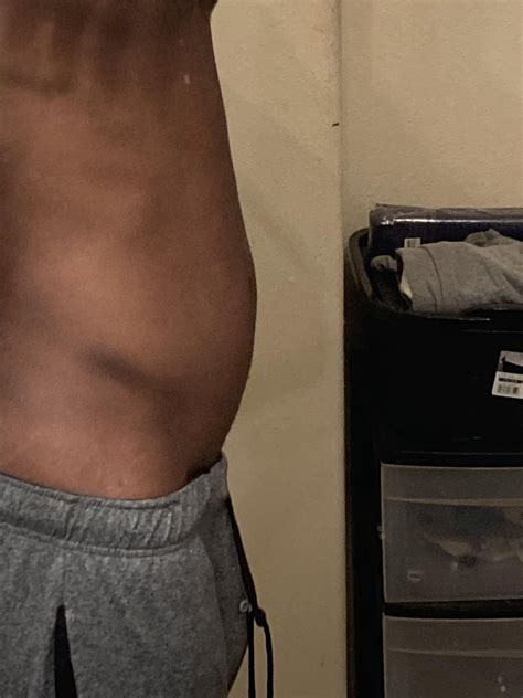 LACTULOSE BREATH HYDROGEN TEST RESULTS : r/SIBO