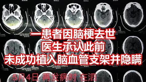 一患者因脑梗去世 医生承认此前 未成功植入脑血管支架并隐瞒 - YouTube