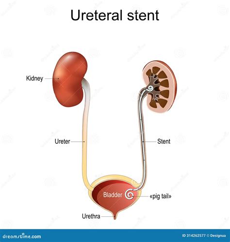 Stent In The Urethra