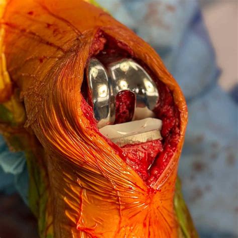 Robotic Knee Replacement | Total Knee Arthroplasty (TKA) | Knee Surgeon ...