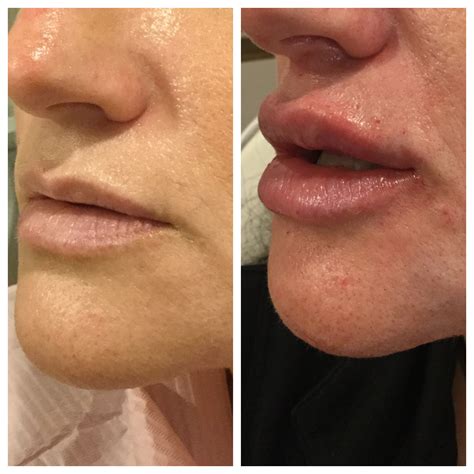 Chin Botox: Dramatic Before & After Transformations – Cost, Results, and More - Chaztin
