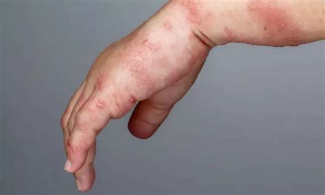 Herpes zoster associated with higher long - term risk of a major ...