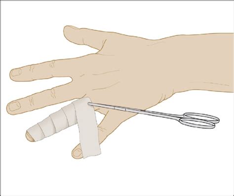 Image result for Ring Removal String Technique