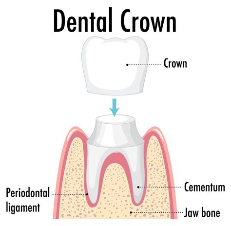 Dental Crowns in Englewood, NJ | Same Day Crowns Near Me