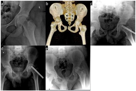 Traumatic Hip Dislocation Associated with Proximal Femoral Physeal ...