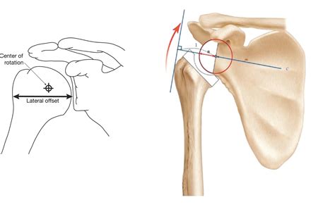 How Common Is Reverse Shoulder Replacement at Lawrence Melson blog