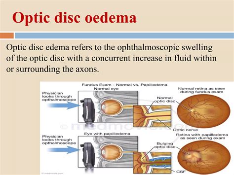 Symptoms Of Optic Disc Edema