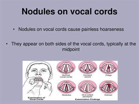 Vocal Nodules Symptoms Treatment More Cleveland Clinic