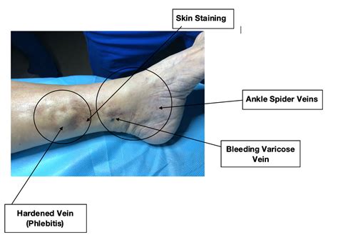 What to look for: A Hardened Vein - Phlebitis