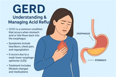 "How to Stop Heartburn Fast: Advice about GERD and Acid Reflux Relief"