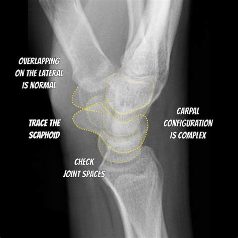 Normal Wrist X Ray Lateral EMRad: Radiologic Approach To The Traumatic