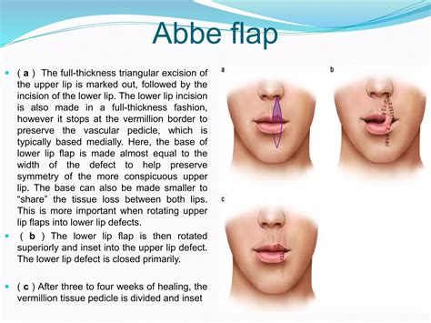 Dr. Rasel lip reconstruction cme DDCH, Dhaka, Bangladesh | PPTX