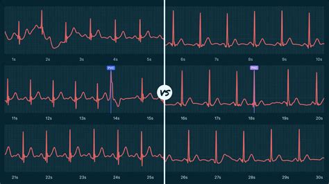 Premature Ventricular Contractions Vs Premature Atrial Contractions