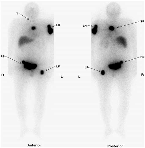 Functioning Metastases from Thyroid Papillary Carcinoma in Bone | Journal of Nuclear Medicine ...