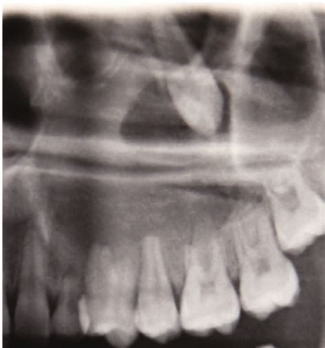 Odontogenic Tumors Simultaneous Occurrence Of Keratocystic Odontogenic