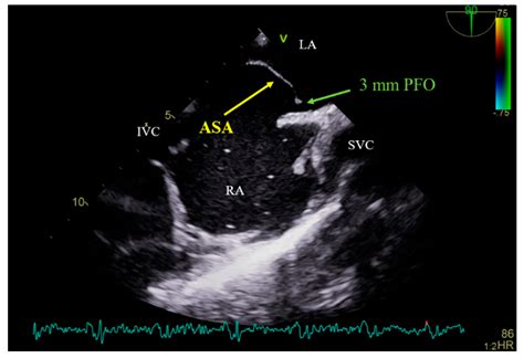 Embolization of Patent Foramen Ovale Closure Device—Rare Complication ...