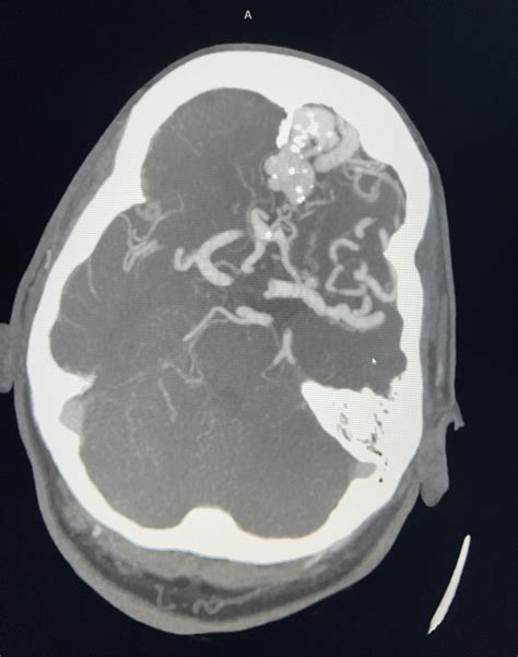 Image result for AVM Brain