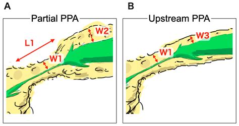 Partial Pancreatic Parenchymal Atrophy Is a New Specific Finding to ...