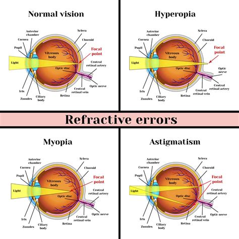 What are Refractive Errors? | Refractive Errors Griffin, GA | Takle Eye Group