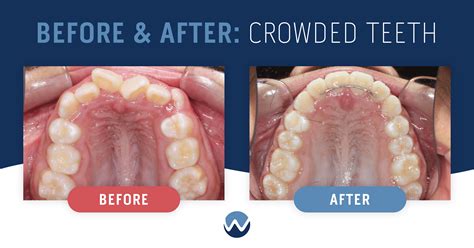 Ways We Can Help With Teeth Crowding • Woodhill Dental Specialties ...