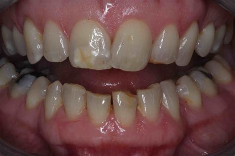 Tooth Bonding Problems