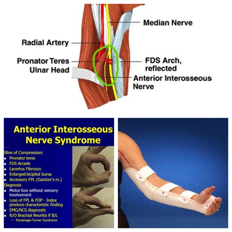 Anterior Interosseous Nerve Syndrome