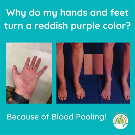 Have you ever noticed that your hands and feet turn a reddish-purplish color? This is something ...