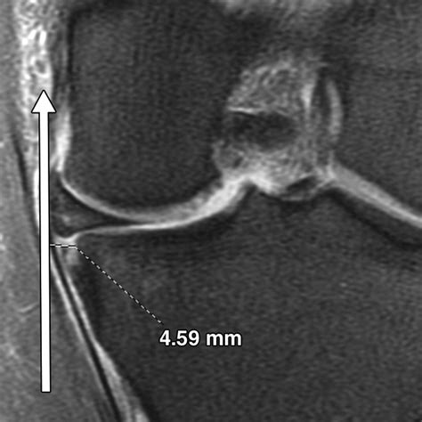 How I Diagnose Meniscal Tears on Knee MRI | AJR
