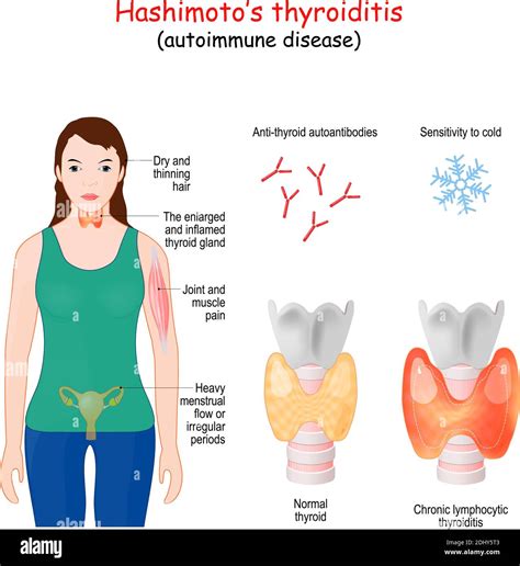 Graves Disease Vs Hashimoto at Eliza Coles blog