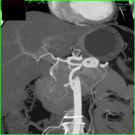 Splenic Artery Aneurysms - Vascular Radiology Case Studies - CTisus CT ...